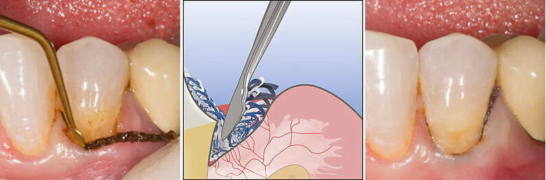 Fig 5. Retraction cord, dry or soaked with the hemostatic agent, is easy to place when the sulcus is no longer bleeding. In many cases, the cord helps placing the marginal side of the cervical matrix correctly after applying the restorative material. 