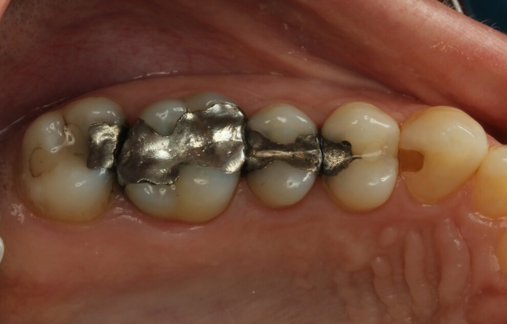 Fig. 1: Initial situation with failing amalgam restorations.