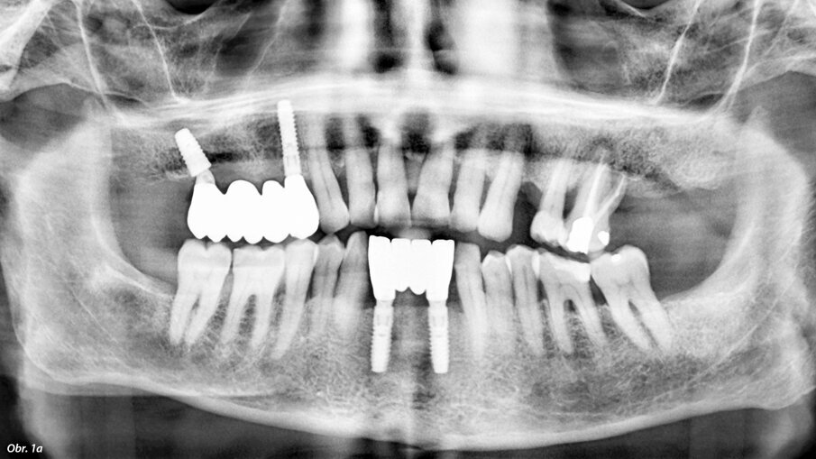 Použitím tilted implantátů využijeme stávající kost bez nutnosti augmentace.