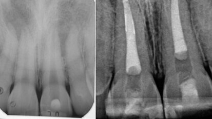 Irrigating the root canal: A case report