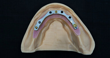 3D fabrication workflow: Solid and lattice-structured titanium alloy dental implant overdenture bars