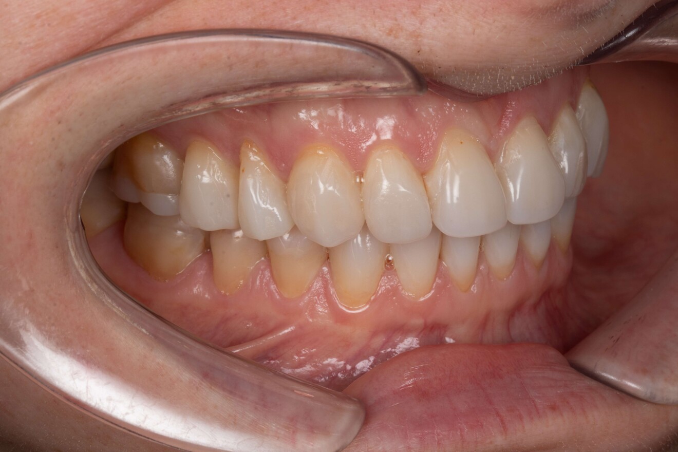 Figg. 8a–c: Viste vestibolari intraorali dopo il trattamento che mostrano la dentizione anteriore e posteriore restaurata e la relazione occlusale stabilita.