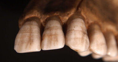Enamel hypoplasia used to indicate gender equality