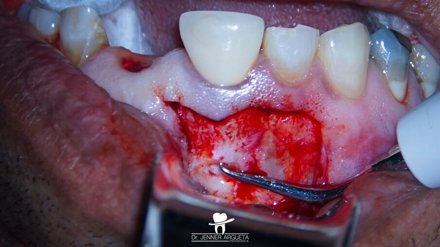 Fig. 11: Ultrasonic retro-preparation of tooth #11 during periapical surgery.