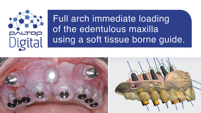 Full arch immediate loading of the edentulous maxilla using a soft tissue borne guide.