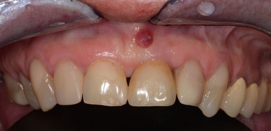 Fig. 13: Initial situation. Visible fistula one year after loading.
