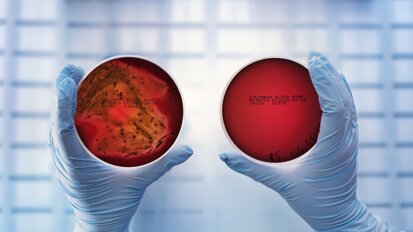 Une thérapie antibactérienne à domicile améliore les résultats parodontaux dans un essai randomisé
