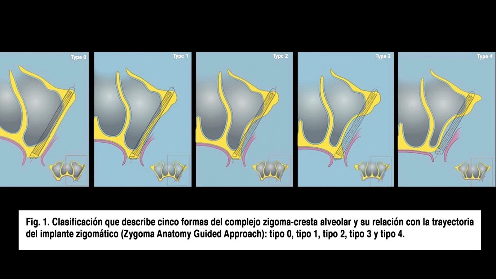 Implantes zigomáticos en el edéntulo maxilar con reabsorción severa