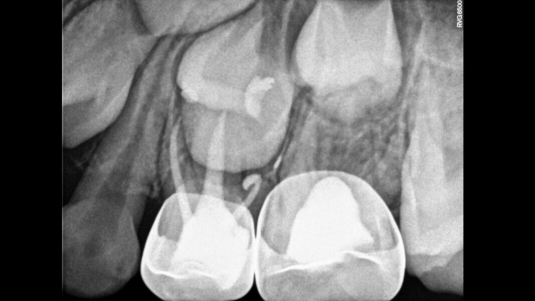 Fig. 22: Thirty-month control showing bone healing around the mesial root and distal root tissue.