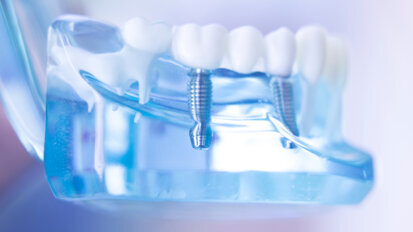 Novel technology could improve efficacy of metal-based dental implants