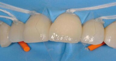 Simple layering technique with direct composite restorations