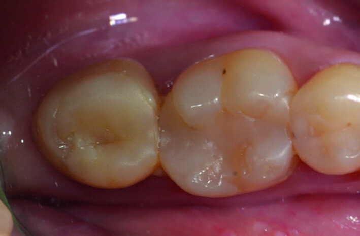 Fig. 17d: Clinical images: Eight-year recall.