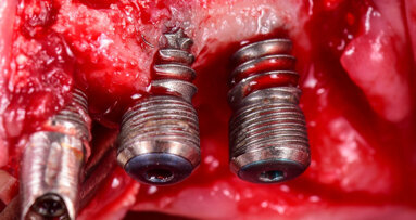 Swiss medical device manufacturer GalvoSurge Dental acquired by Straumann