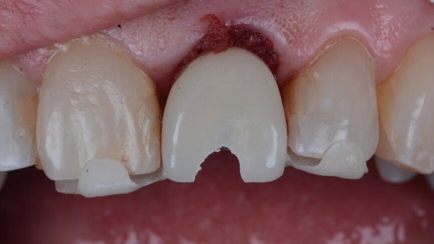 Fig. 25: Temporary provisional tooth shell in position for pick-up of the temporary abutment.