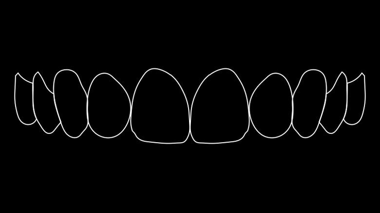 Figura 3. Simulación numérica de la sonrisa ideal.