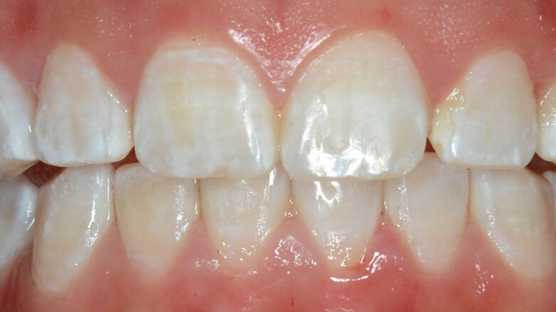 La Microabrasión en Odontología Estética