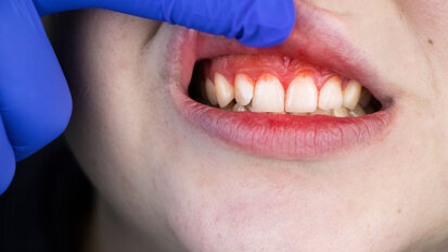 New at-home test for gingivitis