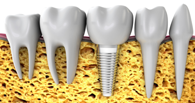 Forscher stellen Bio-Hybrid-Implantat vor