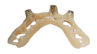 Il posizionatore guidato: modifiche della tecnica attuale  nella protesi implantare immediata
