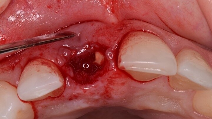 Figura 5. Hundimiento de la zona estética anterior inmediatamente después de la extracción del diente por la reabsorción de la pared vestibular.