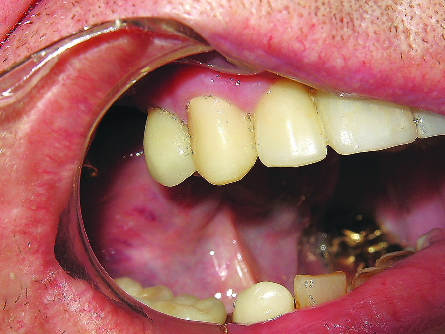 Fig. 11. Temporary crown