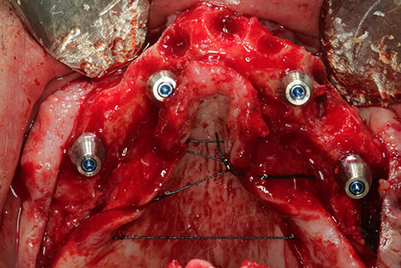 Fig. 15. Imagen oclusal donde se observa el paralelismo obtenido gracias a los pilares transepiteliales asÃ­ como una adecuada distribuciÃ³n antero-posterior (A-P) de los implantes. 