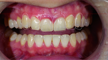 Digital implantology— Predictable aesthetics and functional results