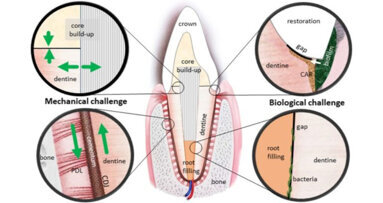 Grundlage für robustere dentale Biomaterialien