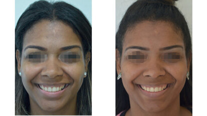 Allongement coronaire chirurgical et toxine botulinique