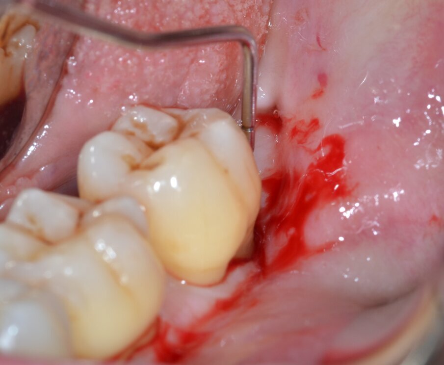 Fig. 2 - Sondaggio parodontale elemento 3.7 (aspetto distale).
