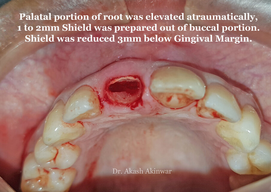 Fig 12: Removal of the palatal fragment