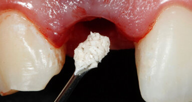 Four questions on Straumann biomaterials