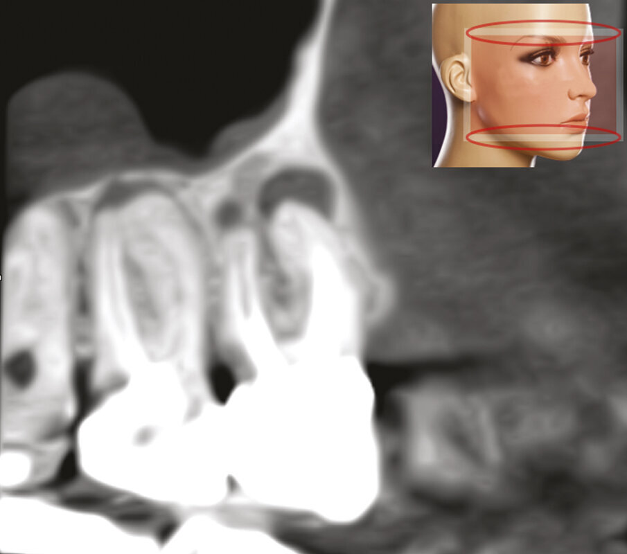 Fig. 1f, 1g - La sezione sagittale mostra ancora meglio le lesioni a carico del primo molare su entrambe le radici vestibolari e le lesioni a carico di entrambe le radici vestibolari del secondo molare, il cui canale MB1 appare completamente vuoto.