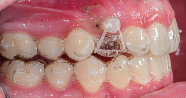 All buttoned up! Styling your plastic with elastics