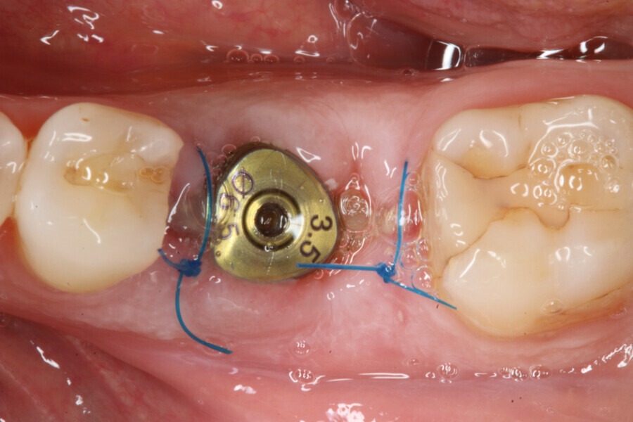 Fig. 10: Clinical situation one week after surgery.