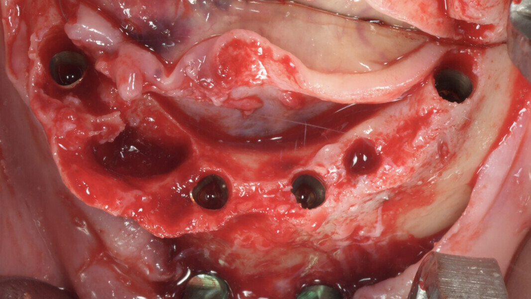 Fig. 10: Occlusal view of placed implants.