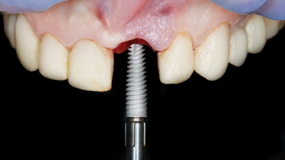 Are copycat brands putting pressure on the dental implant industry in Latin America?
