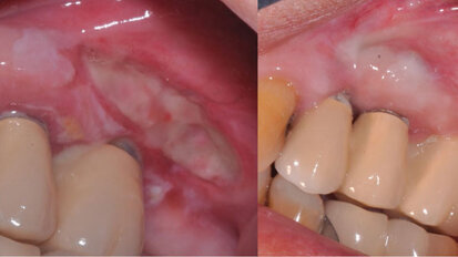 Study: Graft can help improve gums’ support for existing implants
