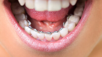 Study finds Saudi Arabians prefer lingual brackets and clear aligners