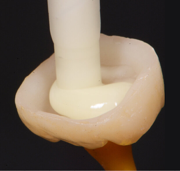 Fig. 7: Applying Variolink Esthetic DC into the crown