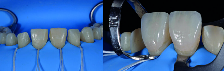 Fig. 16a : Champ d’isolation et essayage de l’ajustement des facettes sur la dent 11 et la dent 21.