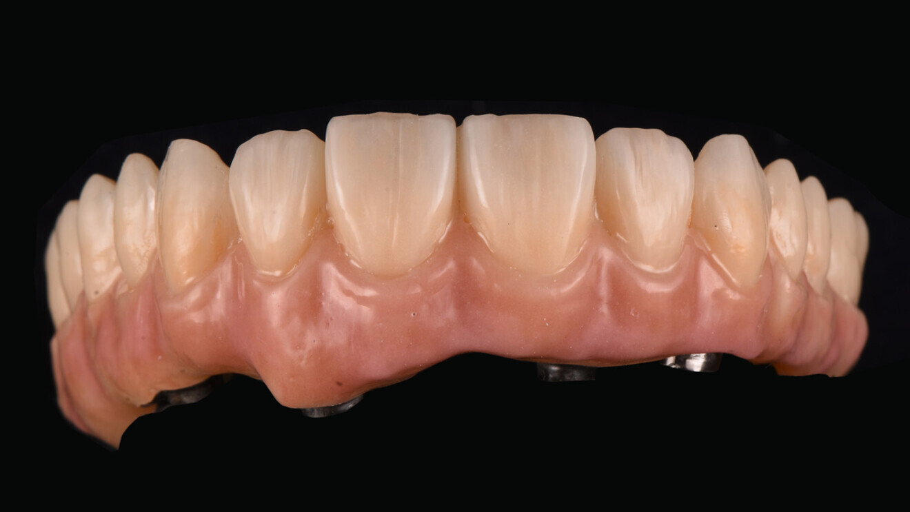 Fig. 5: Restoration after finishing. 