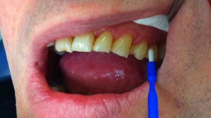Trattamento dell’ipersensibilità dentinale