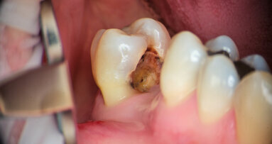 A novel approach to root canal preparation: The in–out technique