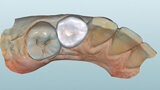 Fig. 8. Vista oclusal de la endocorona virtual en el software CAD.