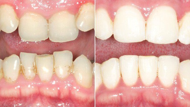 In nur sechs Monaten: Mit Six Month Smile zum perfekten Lächeln
