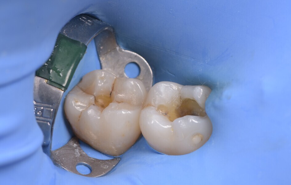 Fig. 2: Situation after removal of the amalgam restorations. 