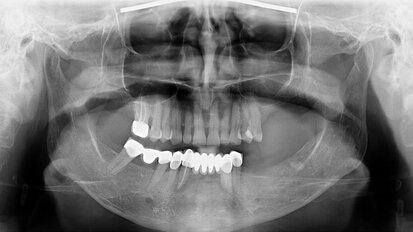 Fully digital prosthetic workflow for mandibular full-arch rehabilitation
