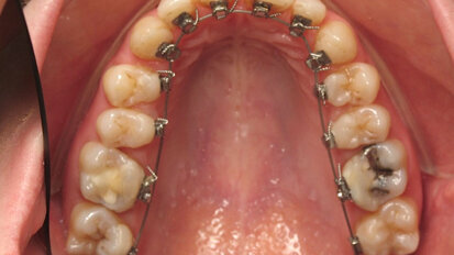 Figura 1. Paciente con tratamiento de ortodoncia lingual.