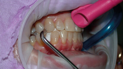 Procedura per il controllo dell’AP/EP (Air Polishing Ergonomics Procedure): tecnica, sicurezza e comfort del paziente